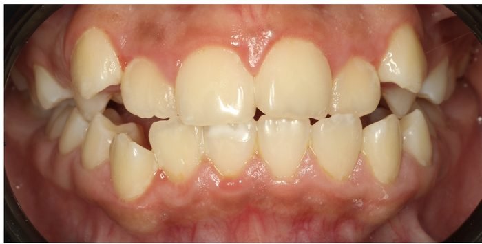 Antes: espacios entre dientes anteriores