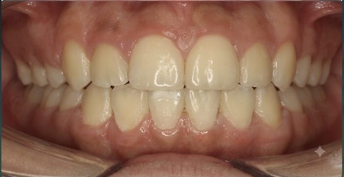 Después: Espacios cerrados y dientes alineados.