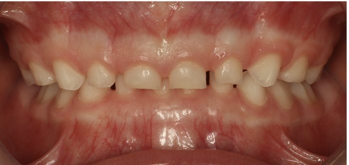 Después: Los dientes de abajo quedaban por delante de los de arriba: mordida corregida.