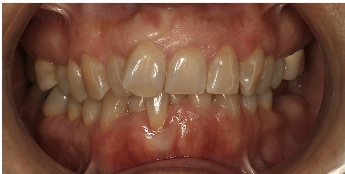 Antes: apiñamiento con rotación dentaria
